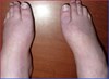 ASYMMETRYBODY veroorzaakt misvorming van de voeten- SYMMETRYBODY 