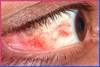 Cataract- Het herstelpercentage van cataract is 98,5 SYMMETRYBODY