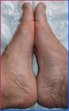 Het herstelpercentage van hallux valgus is 98,5%- SYMMETRYBODY