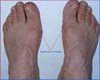 Trichophyton rubrum= Onychomycosis= kalknagel of schimmelnagel. Voordat bewegingsbehandeling- SYMMETRYBODY