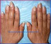 Nadat bewegingsbehandeling-The recovery percentage of nail psoriasis is %98-SYMMETRYBODY