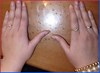 ASYMMETRYBODY veroorzaakt misvorming van vingers en nagels-SYMMETRY BODY