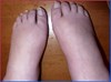 ASYMMETRYBODY veroorzaakt vocht in voeten- SYMMETRYBODY