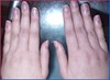 ASYMMETRYBODY veroorzaakt misvorming van vingers en nagels-SYMMETRYBODY
