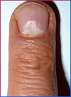 ASYMMETRYBODY veroorzaakt deuk in de nagels- SYMMETRYBODY